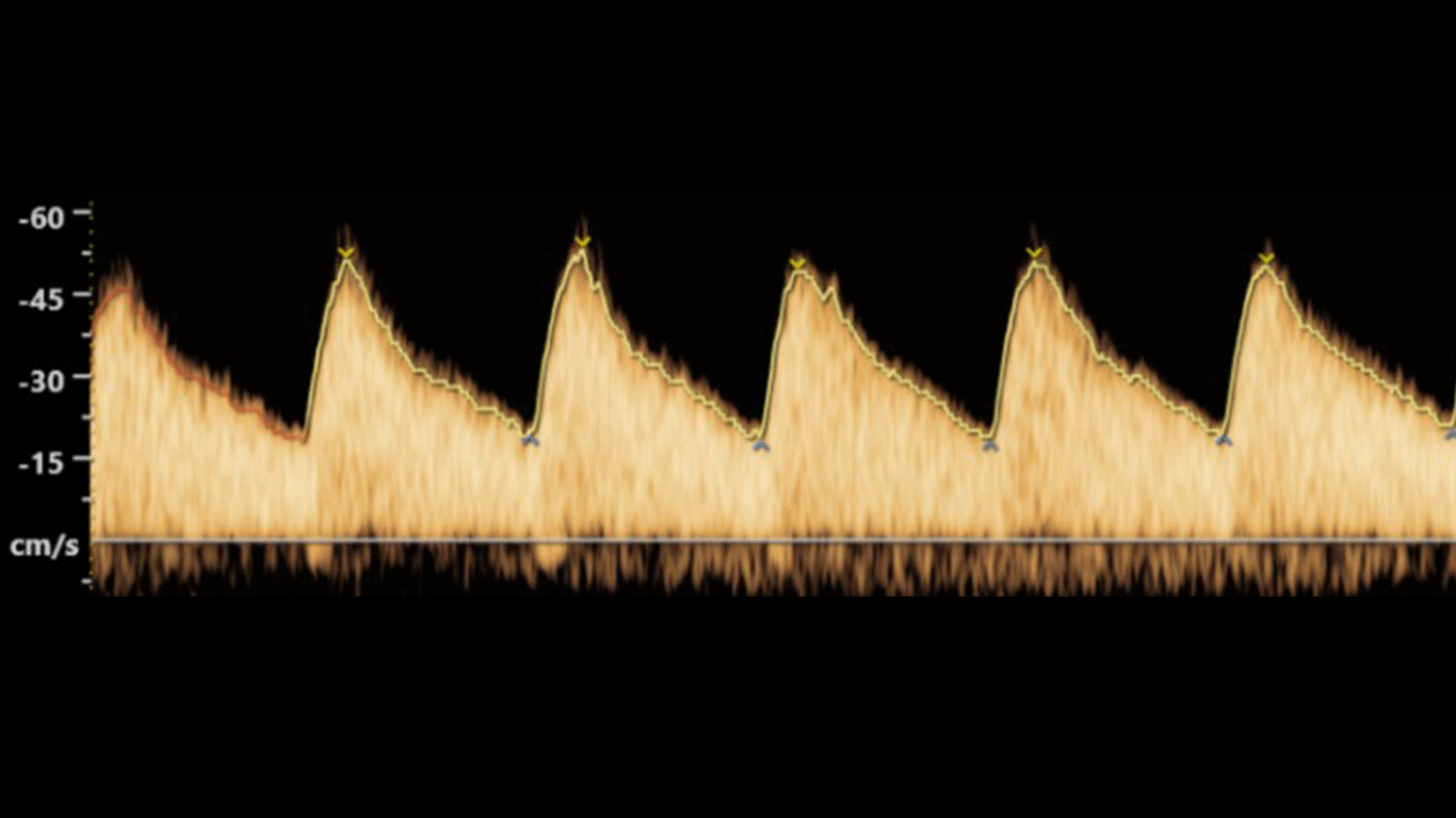 Normal umbilical artery Doppler waveform
